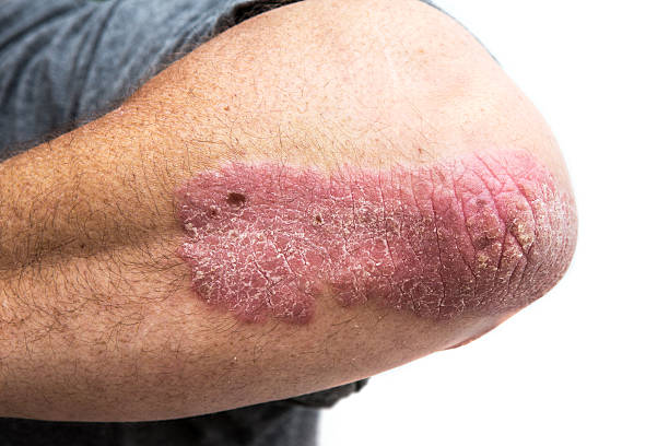 The 9 Best Home Remedies for Psoriasis