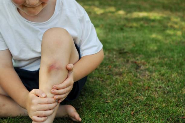 Home Remedies for Bruises